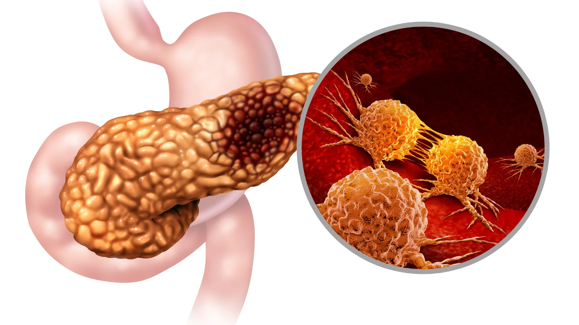 Kanceri i pankreasit